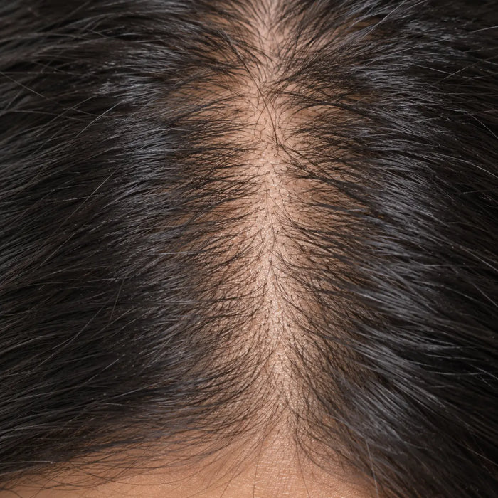 Hair Fall & Thinning